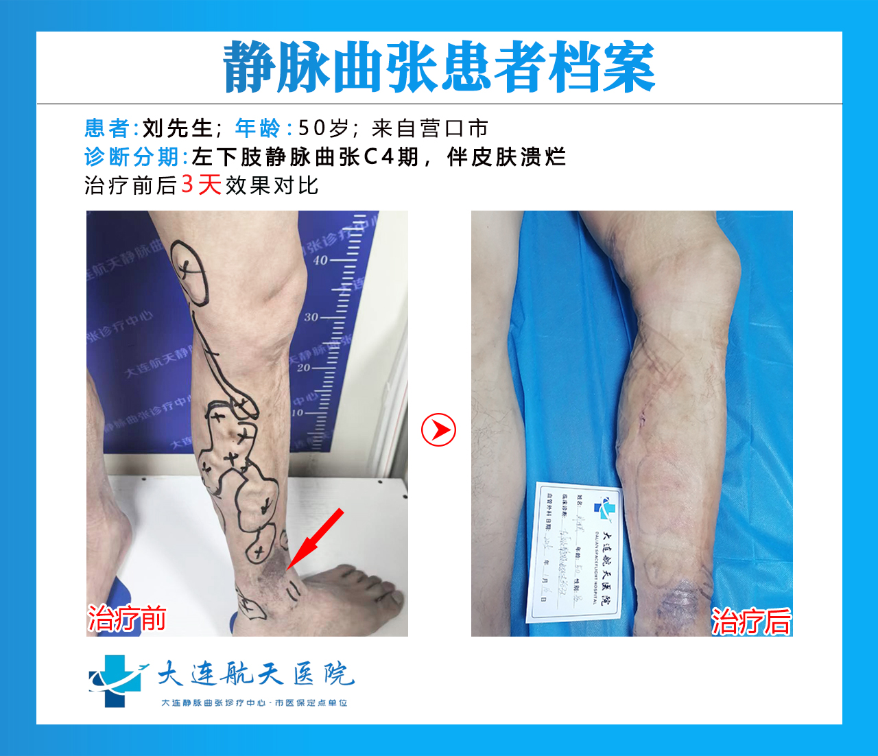 大连刘汝武术后3天对比