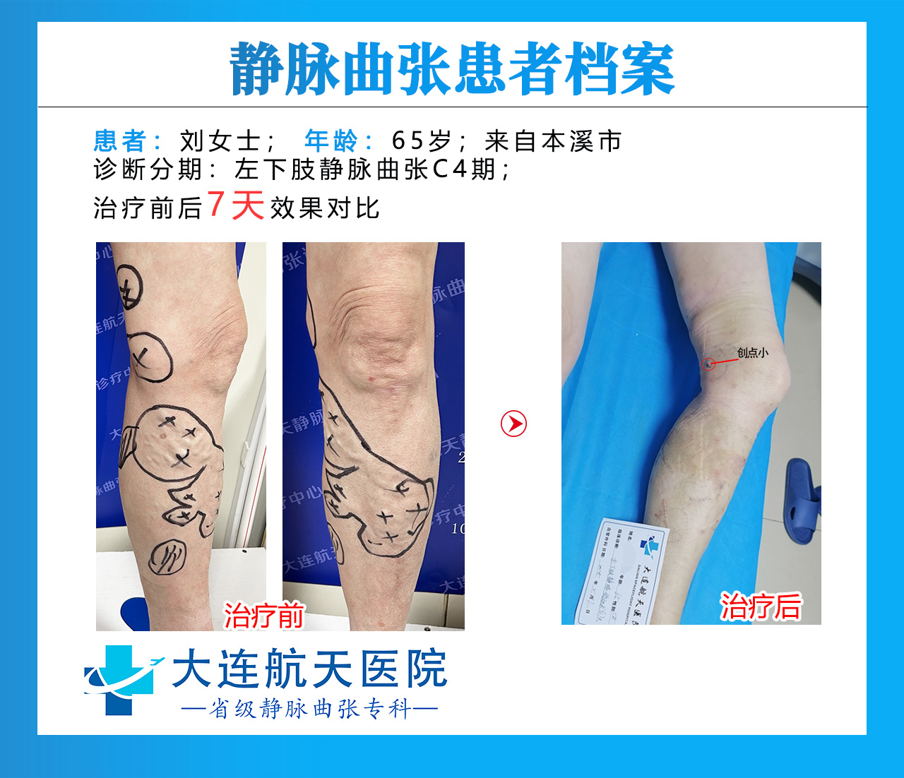 刘美艳术后7天