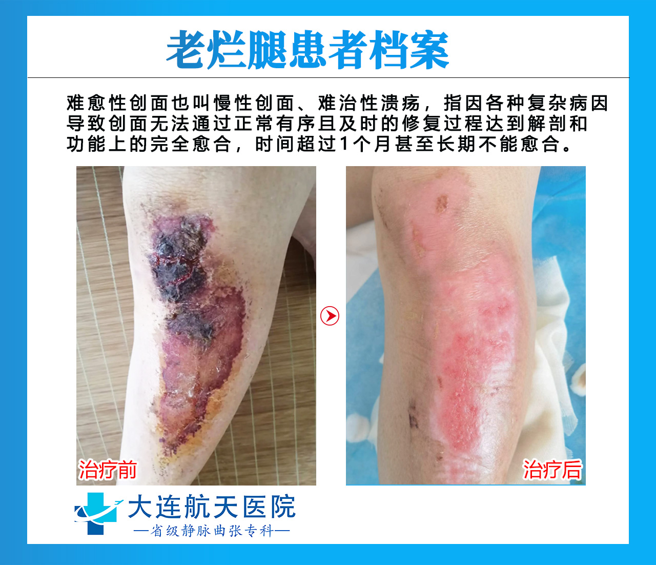 老烂腿对比