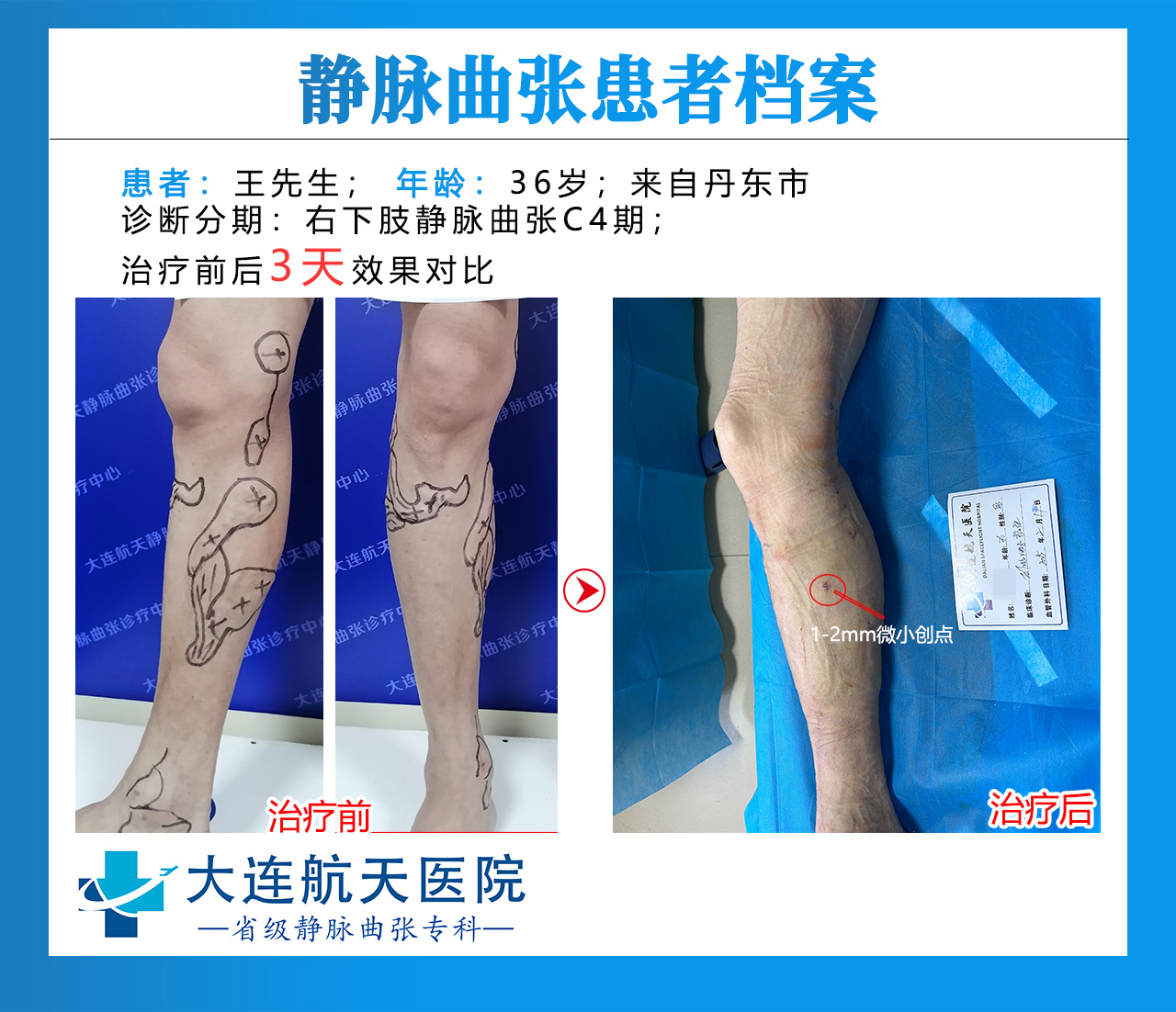 王海涛术后3天对比