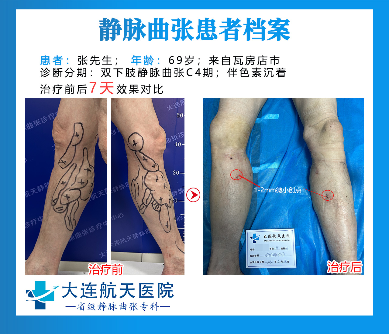 张新贵术后7天对比