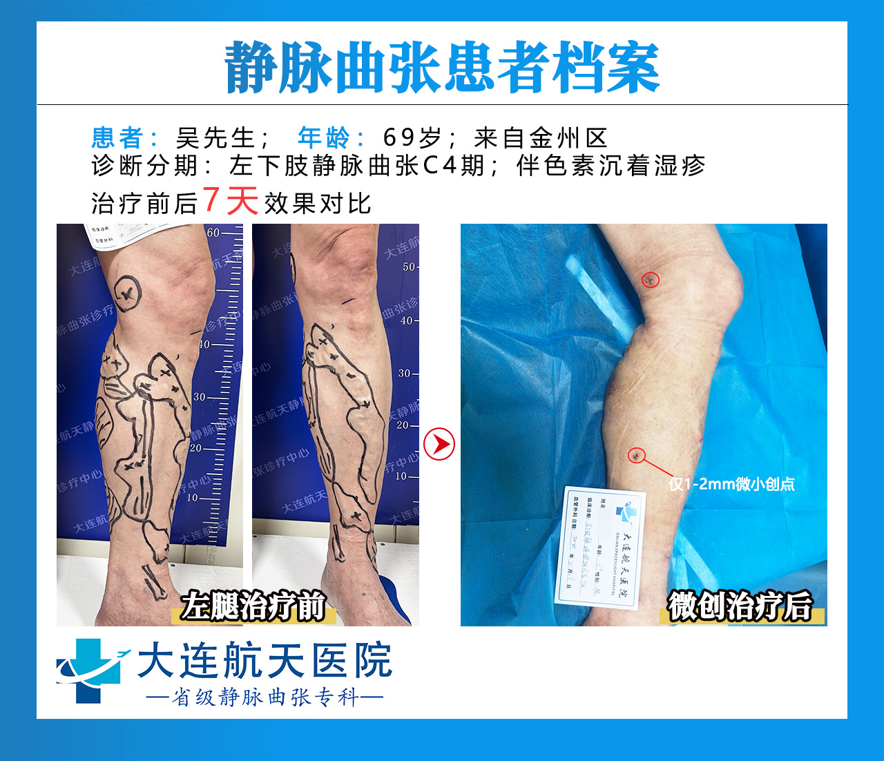 吴贵成术后7天对比