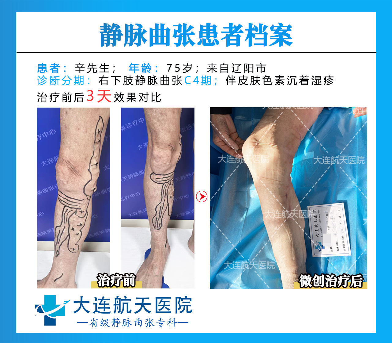 辛贵礼术后3天对比