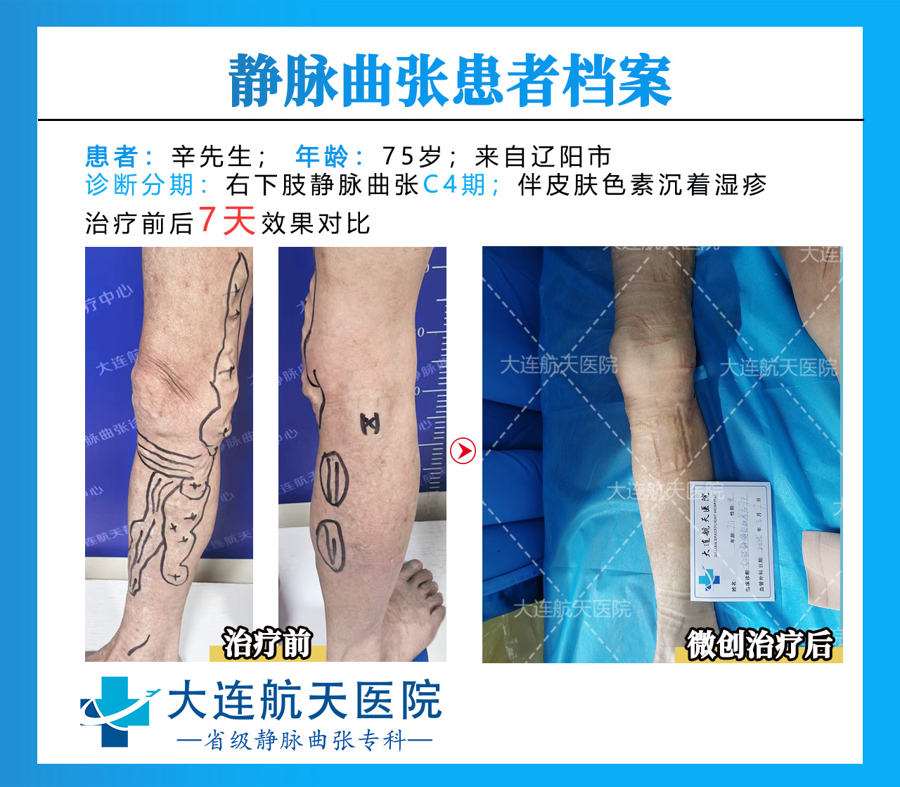 辛贵礼术后7天对比