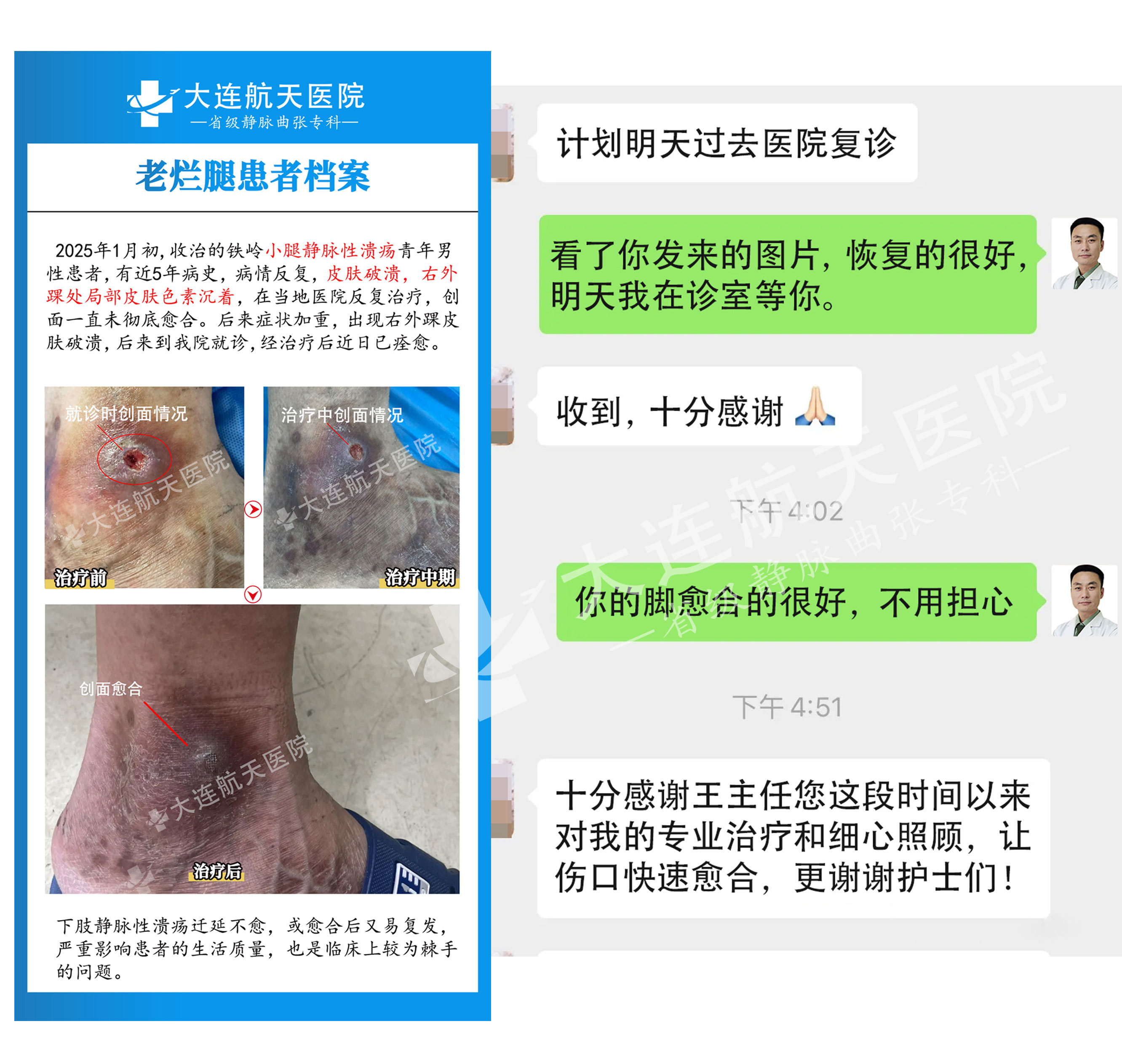 下肢静脉性溃疡案例2