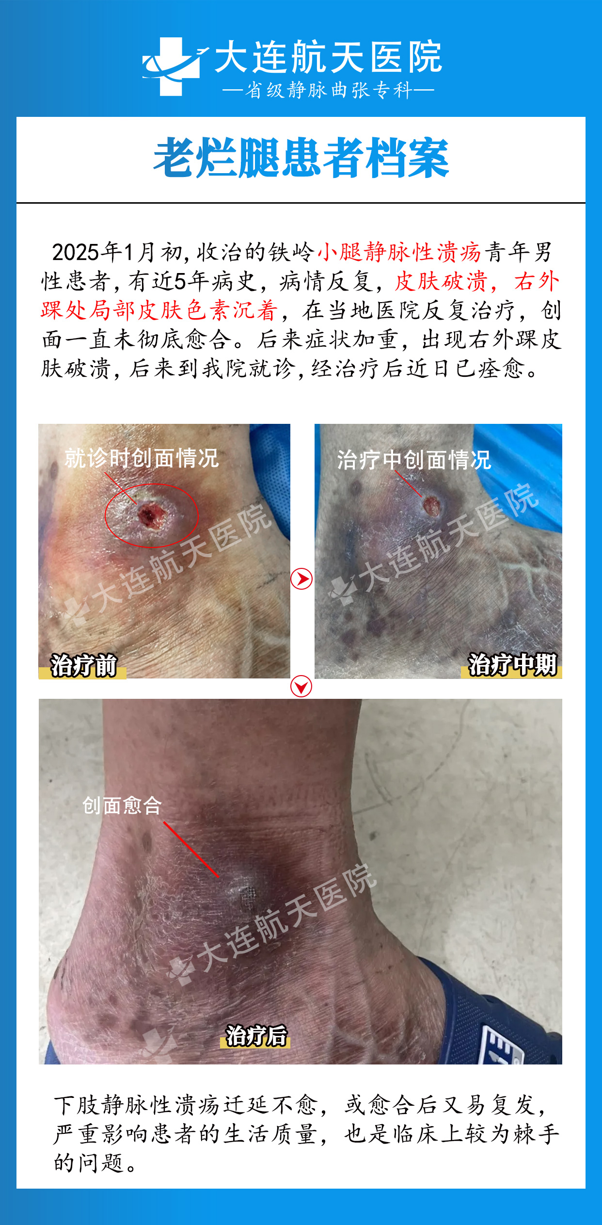 下肢静脉性溃疡案例