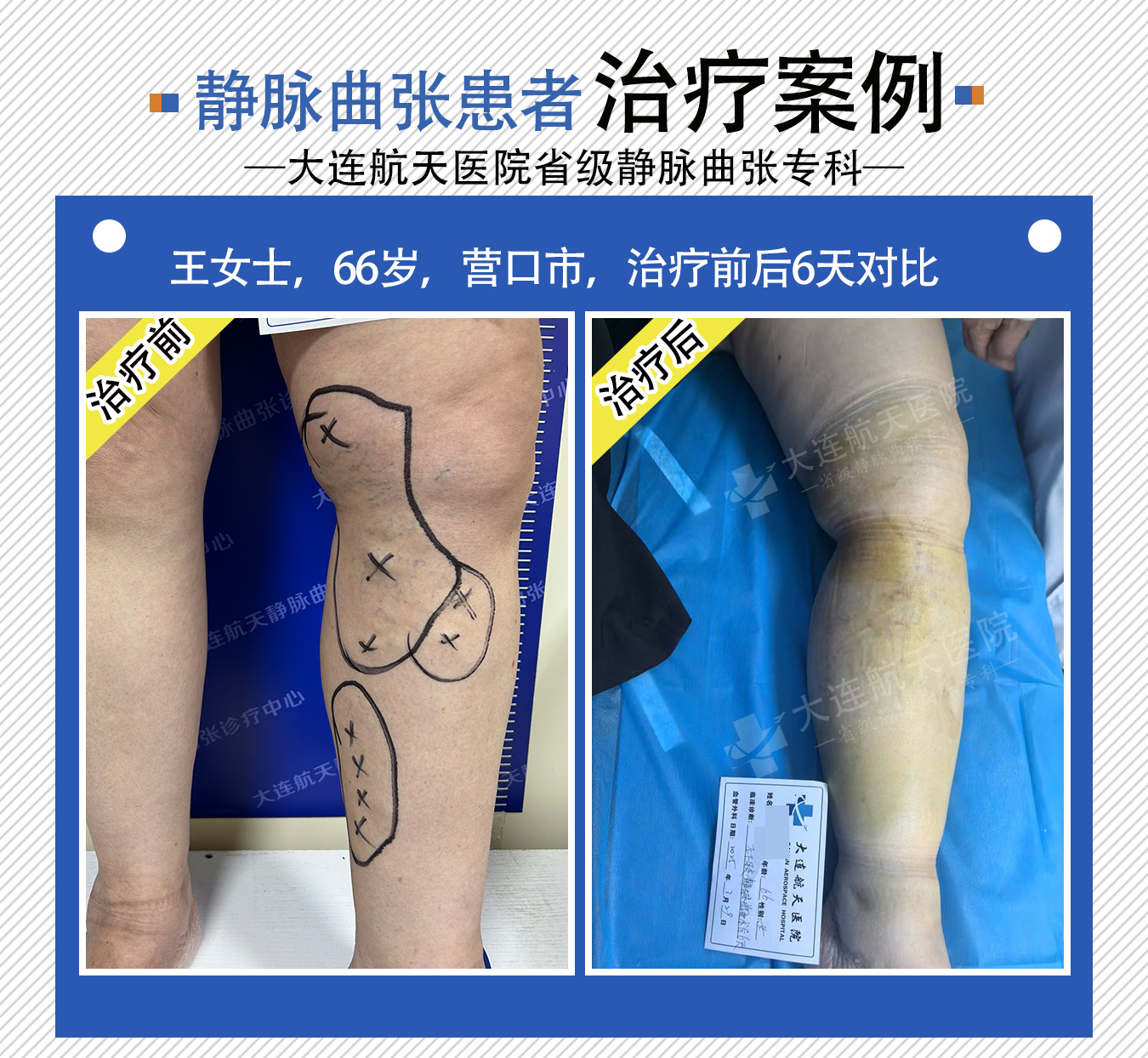 王爱玲术后6天对比