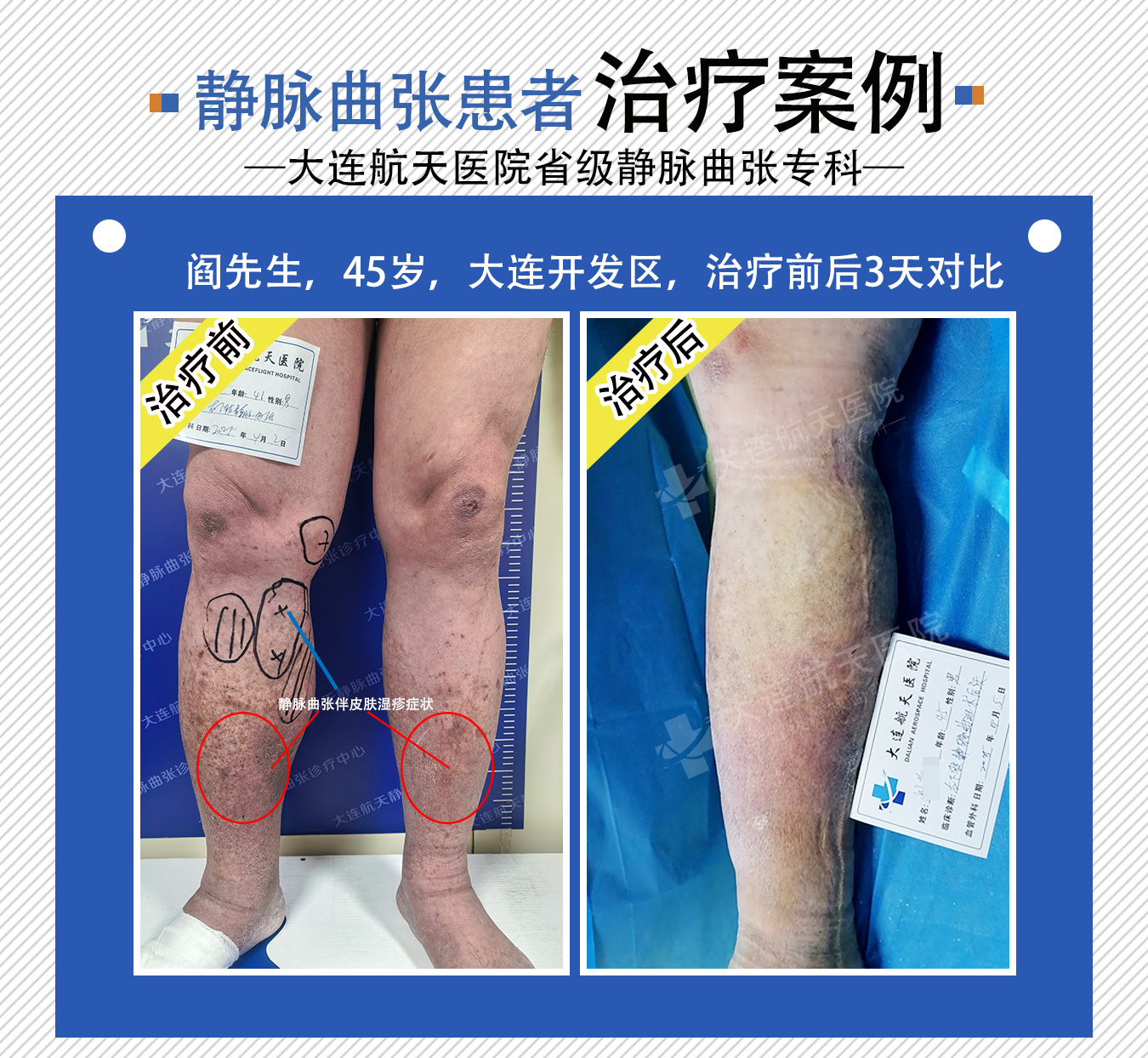大连阎孝顺-术后3天