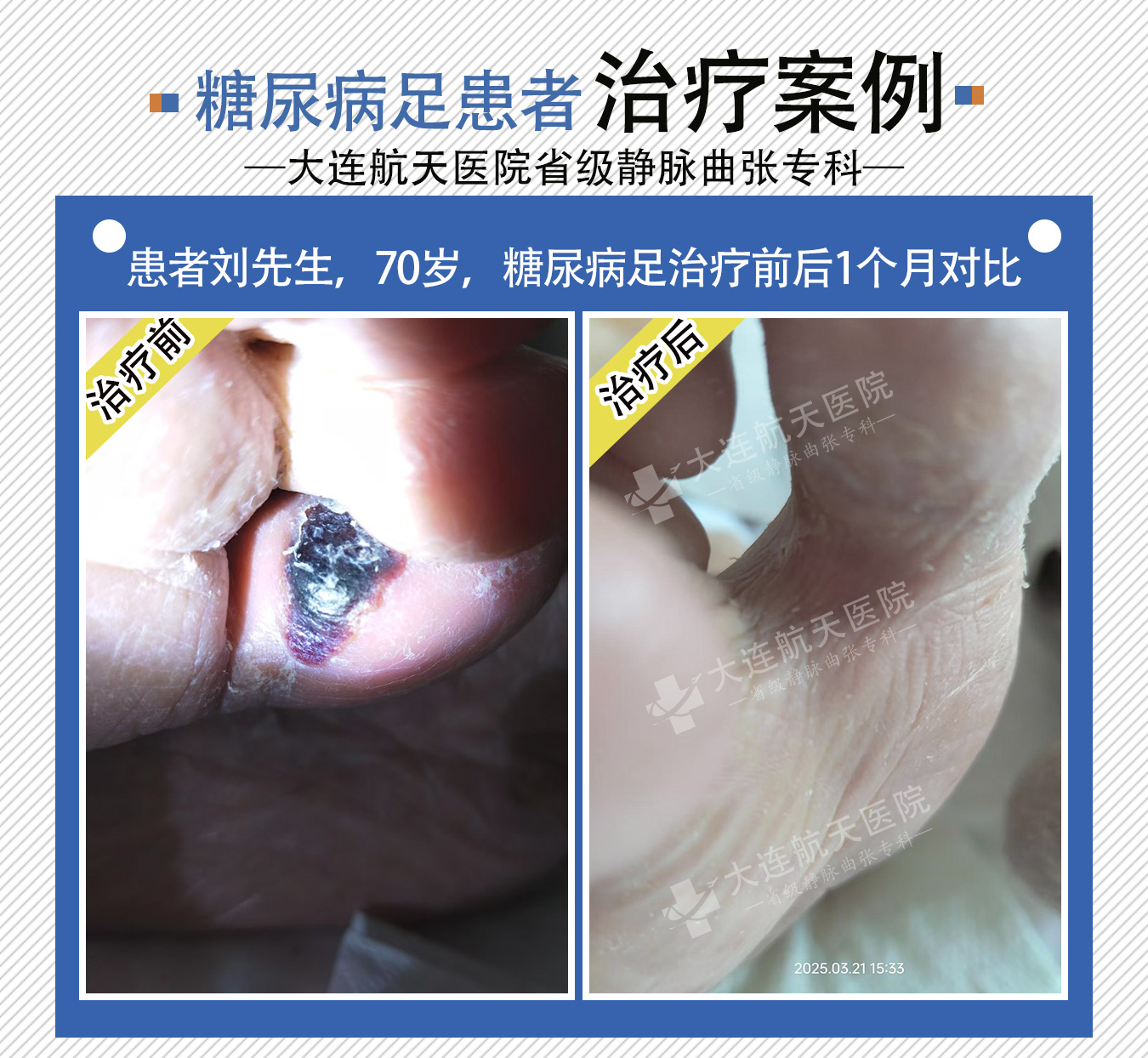 大连刘广荣糖尿病足对比