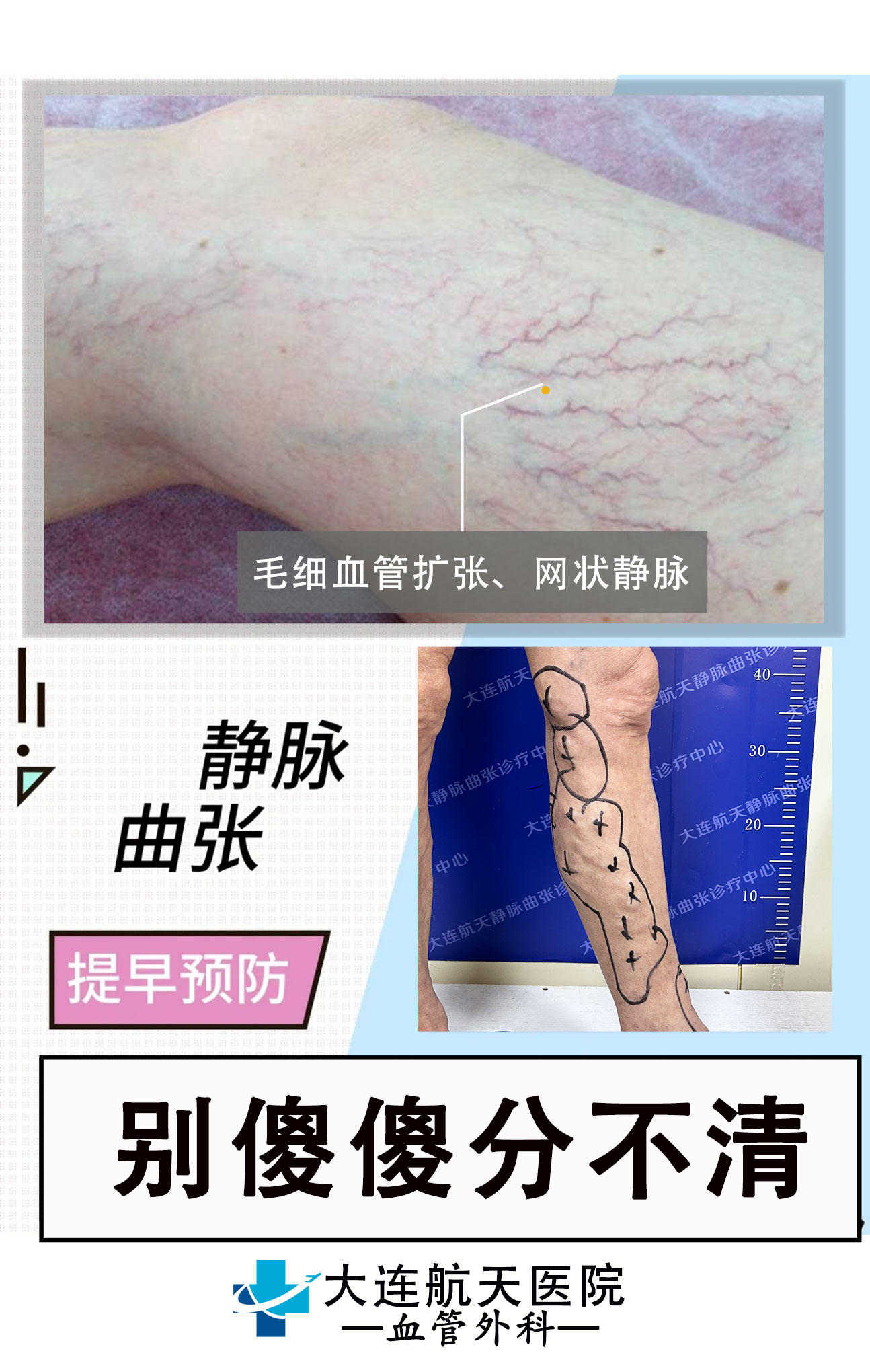 毛细血管静脉曲张对比大连1
