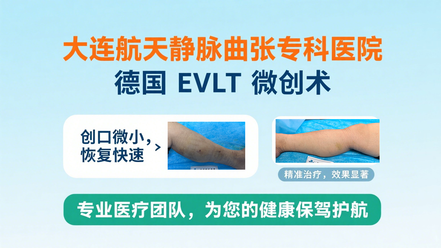 大连航天医院EVLT