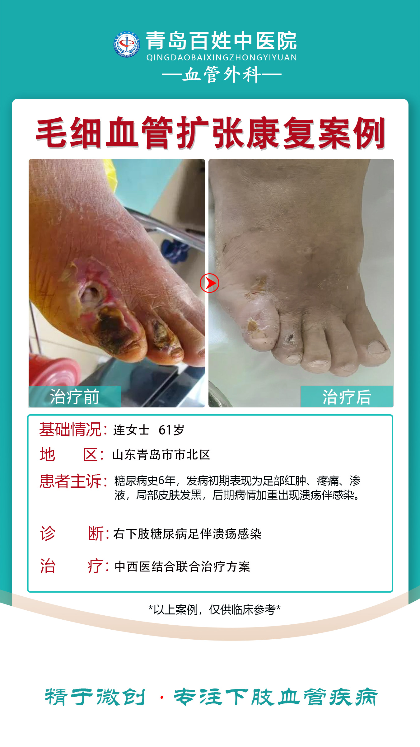 青岛案例糖尿病足伴感染