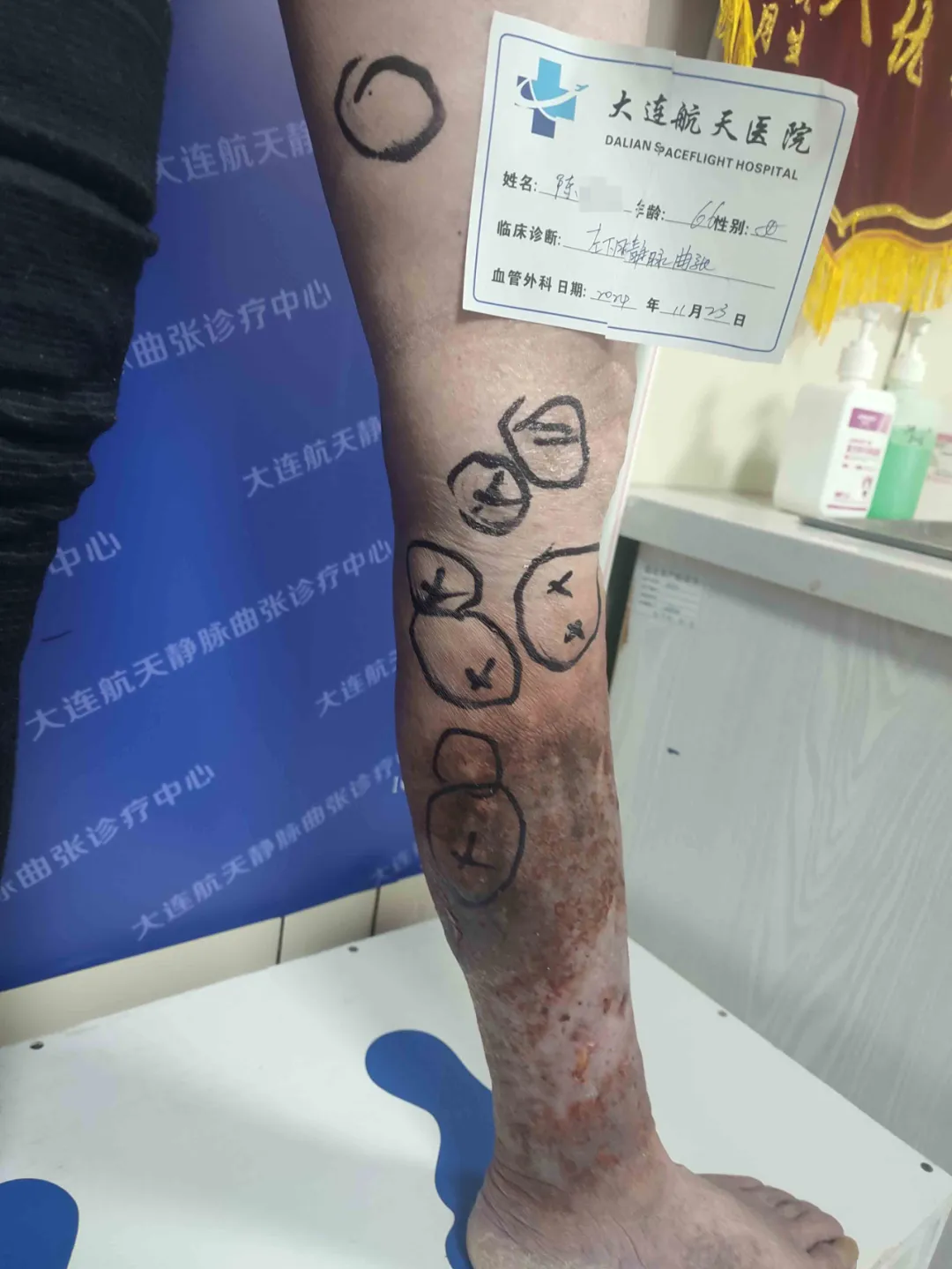 66岁慕名就医下肢静脉曲张患者，感恩赠锦旗致谢王宝珠主任团队！(图1)