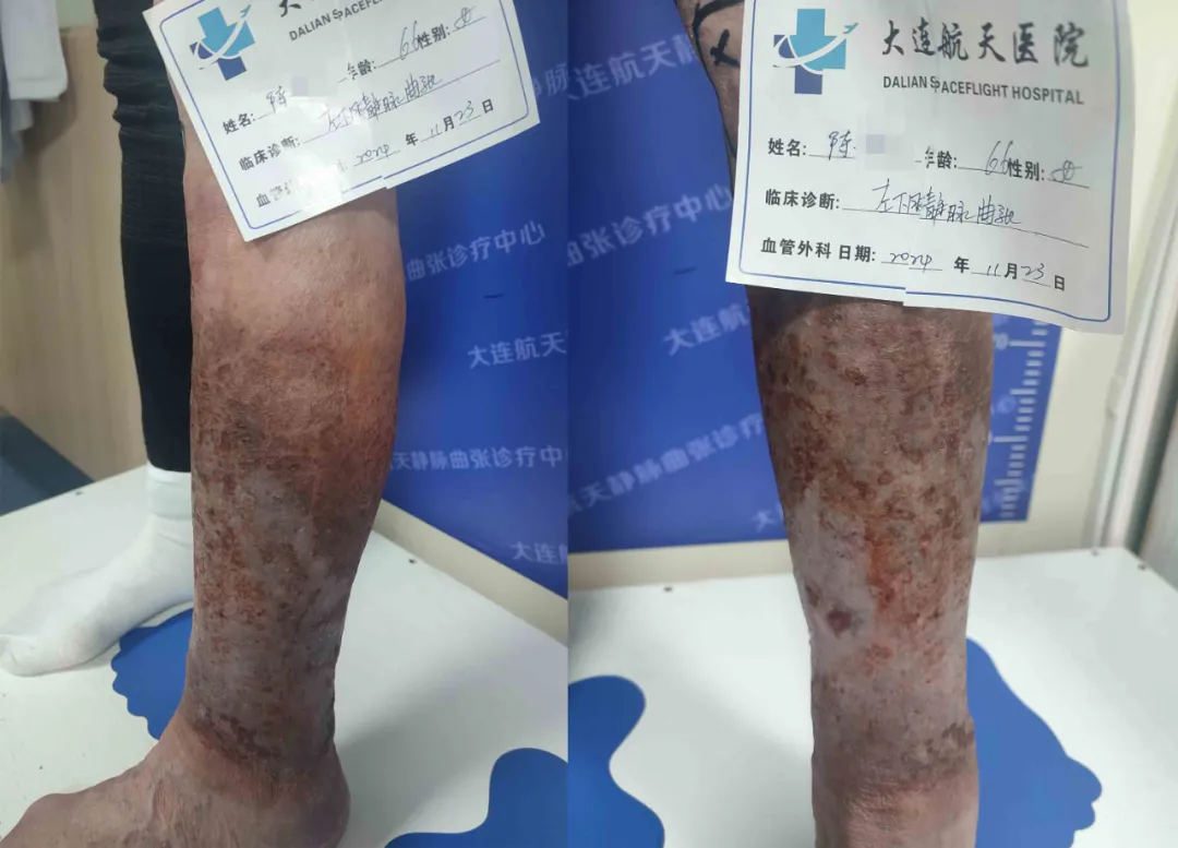 66岁慕名就医下肢静脉曲张患者，感恩赠锦旗致谢王宝珠主任团队！(图2)