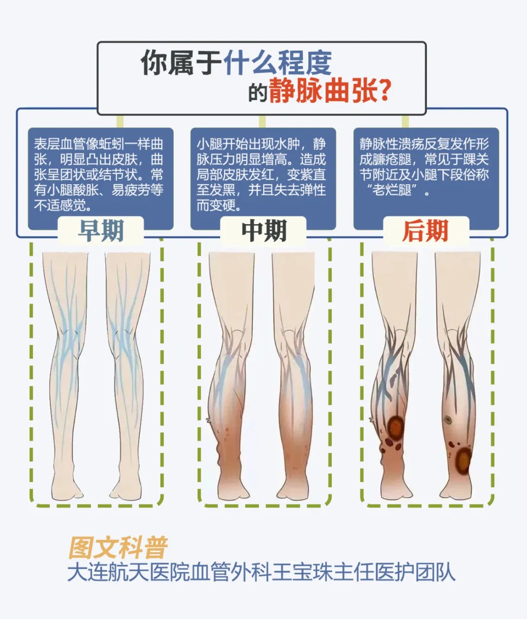大连航天医院德国evlt微创治疗下静脉曲张实现“即做即走” (图1)