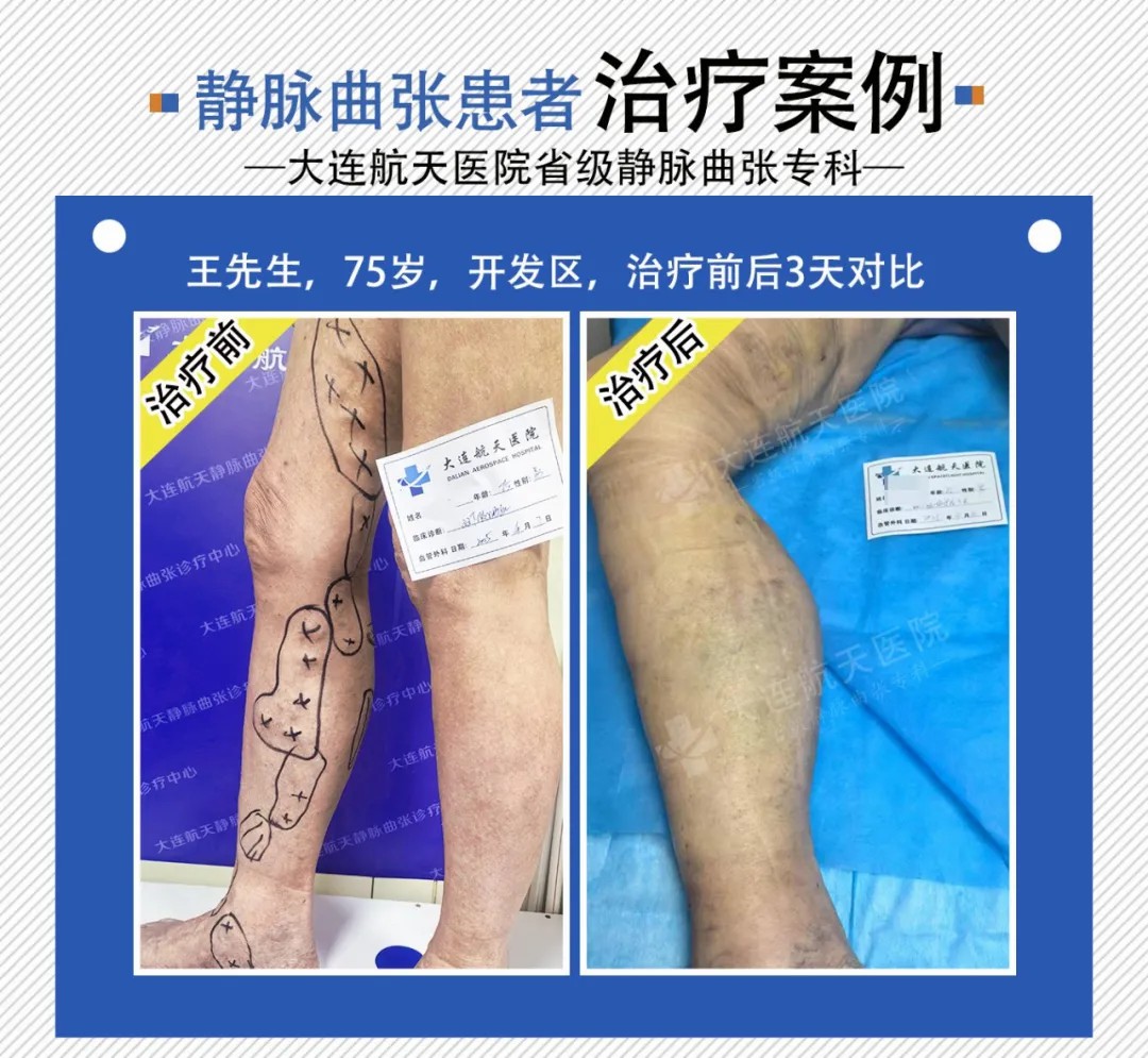 静脉曲张是怎么引起的原因