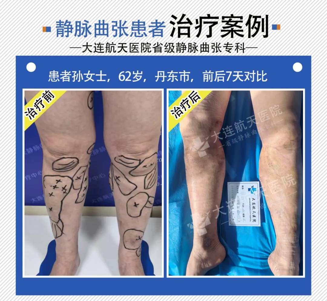 大连航天医院德国evlt微创治疗下静脉曲张实现“即做即走” (图4)