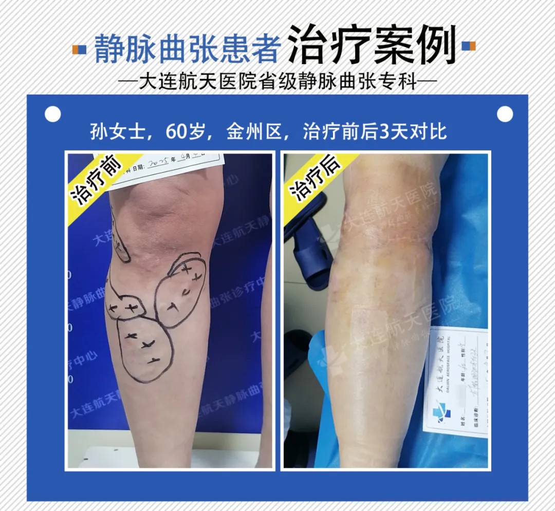 大连航天医院德国evlt微创治疗下静脉曲张实现“即做即走” (图3)