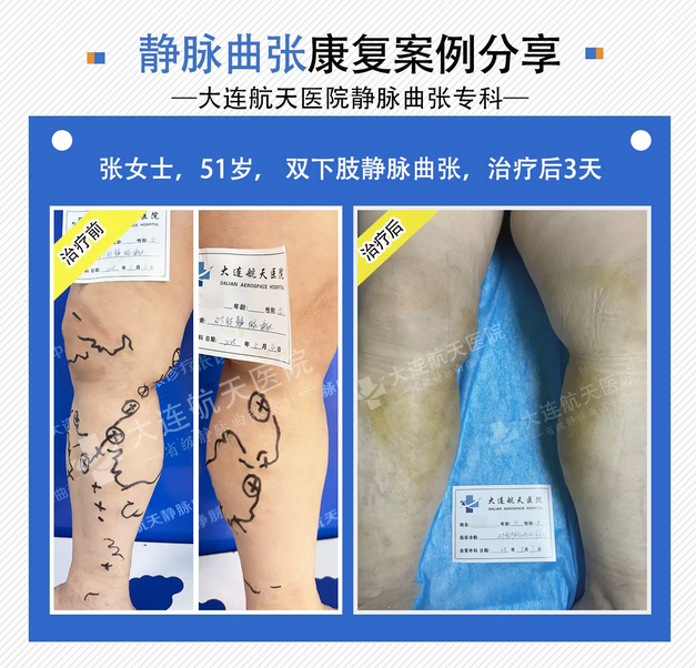 彭兴伟谈：静脉曲张患者最关心的3个问题！ (图1)