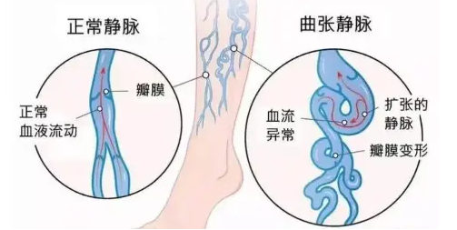 那些年,我们误解的下肢静脉曲张!(图1)
