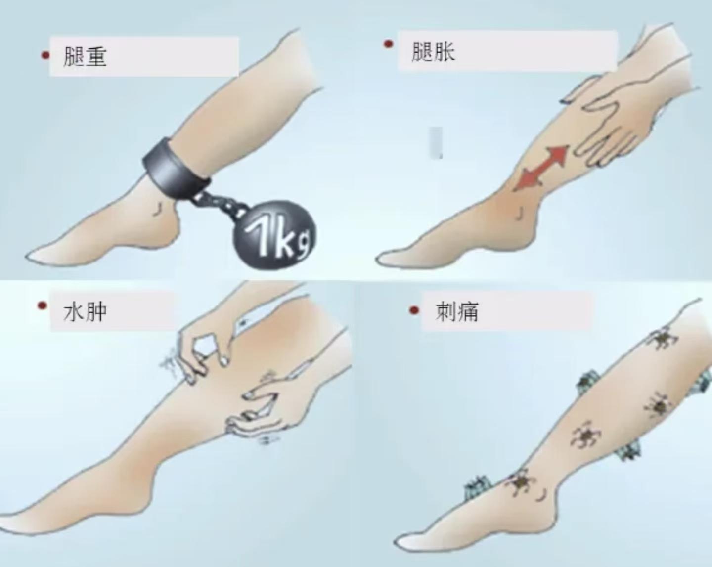 静脉曲张症状表现