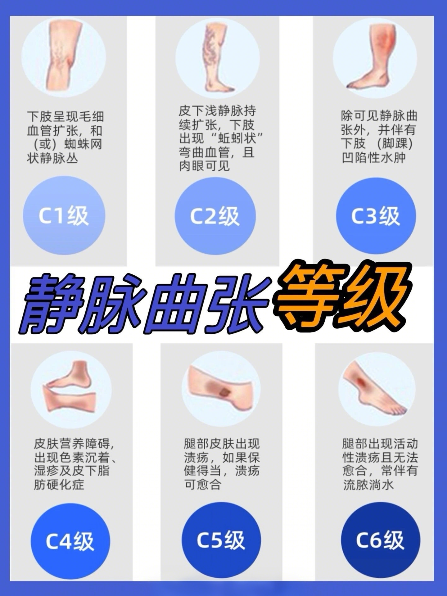 静脉曲张等级划分