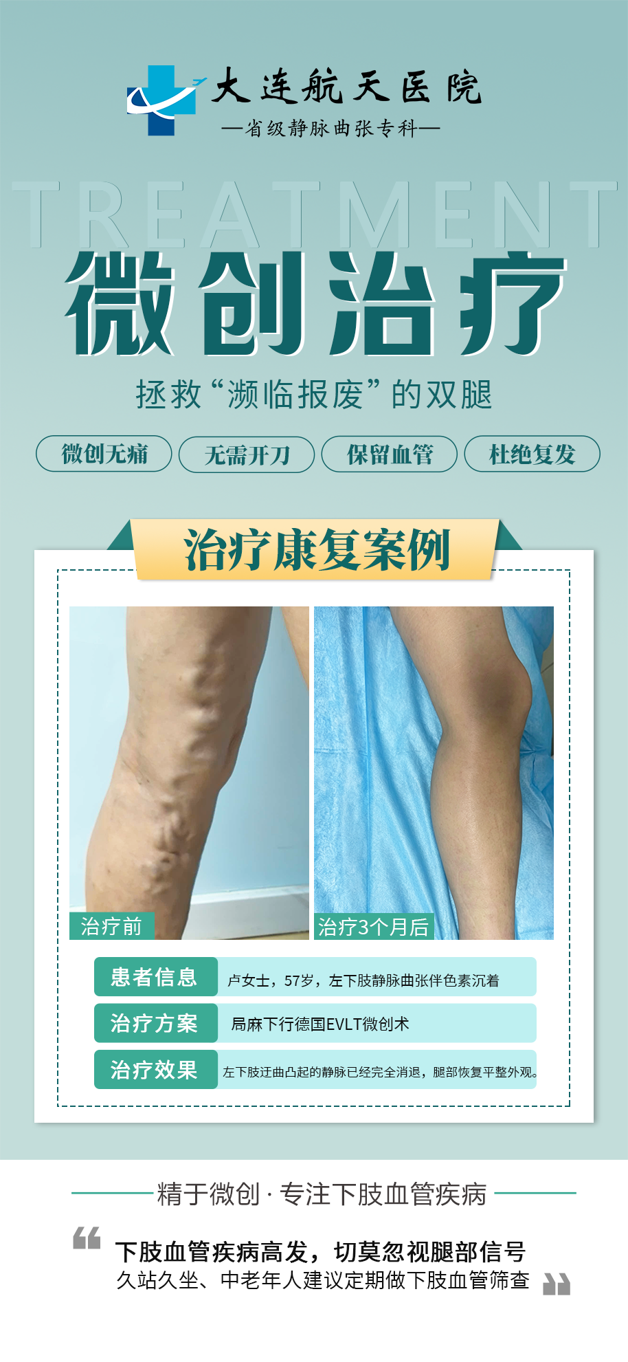 静脉曲张康复案例|德国 EVLT 微创治疗,患者真实恢复情况 (图3) 静脉曲张康复案例|德国 EVLT 微创治疗,患者真实恢复情况 (图3)